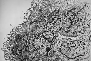 F,1y. | plexus papilloma F,1y. | plexus papilloma